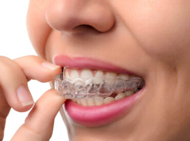 invisalign-1